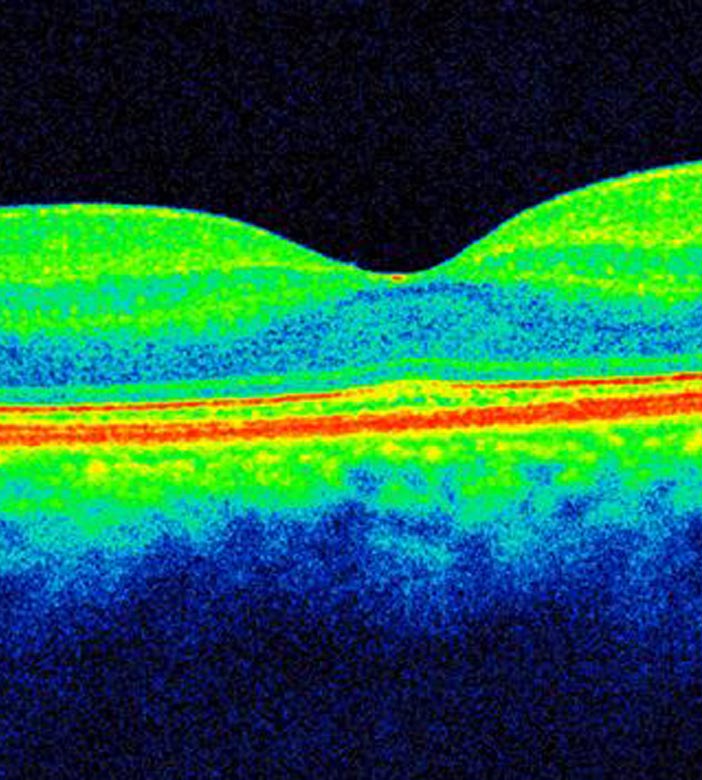Optical Coherence Tomography or White Light Interferometry